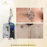 Máy Laser ND YAG Q-Switch SL-NY 602 | Bắc Kinh