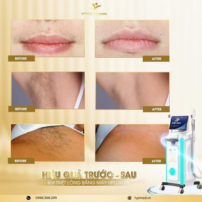 Máy Triệt Lông HPLUXURY 💎 Bước Tiến Mới Của Công Nghệ AI Trong Thẩm Mỹ Hiện Đại 11 Máy Triệt Lông Diode Laser Cao Cấp