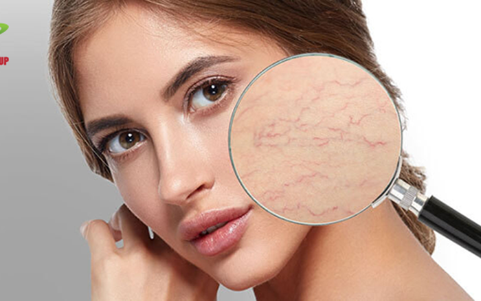 Sửa Máy Laser 980nm Điều Trị Giãn Mao Mạch Sanhe - Dịch Vụ Chuyên Nghiệp và Hiệu Quả